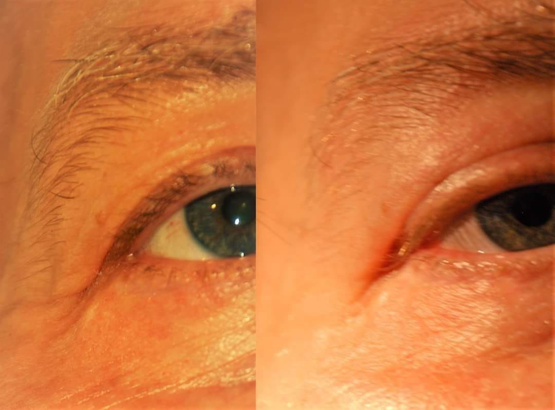 before and after ONE APPLICATION